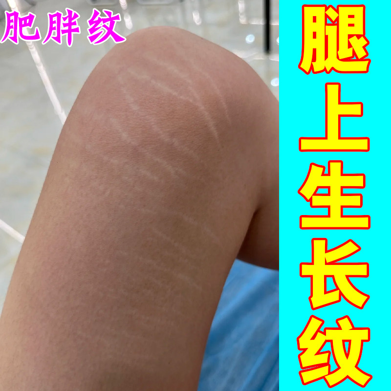 去肥胖纹生长纹修复霜消除大腿学生膨胀纹预防妊娠纹淡化祛除疤膏