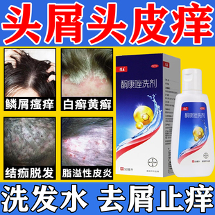 酮康唑洗剂发水脂溢性皮炎专用药洗剂头皮屑官方旗舰店严重去头屑