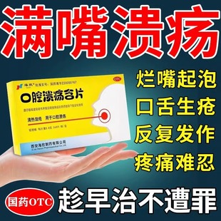 口腔溃疡专用药口腔溃疡含片口舌生疮药嘴巴上火起泡舌头溃疡口疮