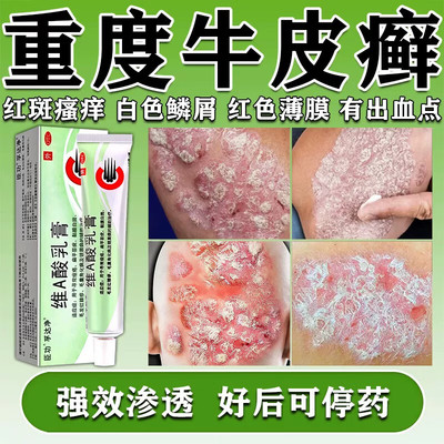 维A酸乳膏治牛皮癣银屑病专用药膏皮肤瘙痒体癣去癣止痒药旗舰店