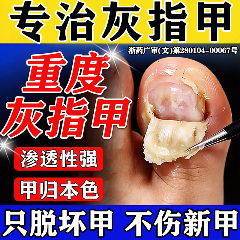 治疗重度灰指甲的药膏指甲增厚发黄变厚真菌感染皮肤用药
