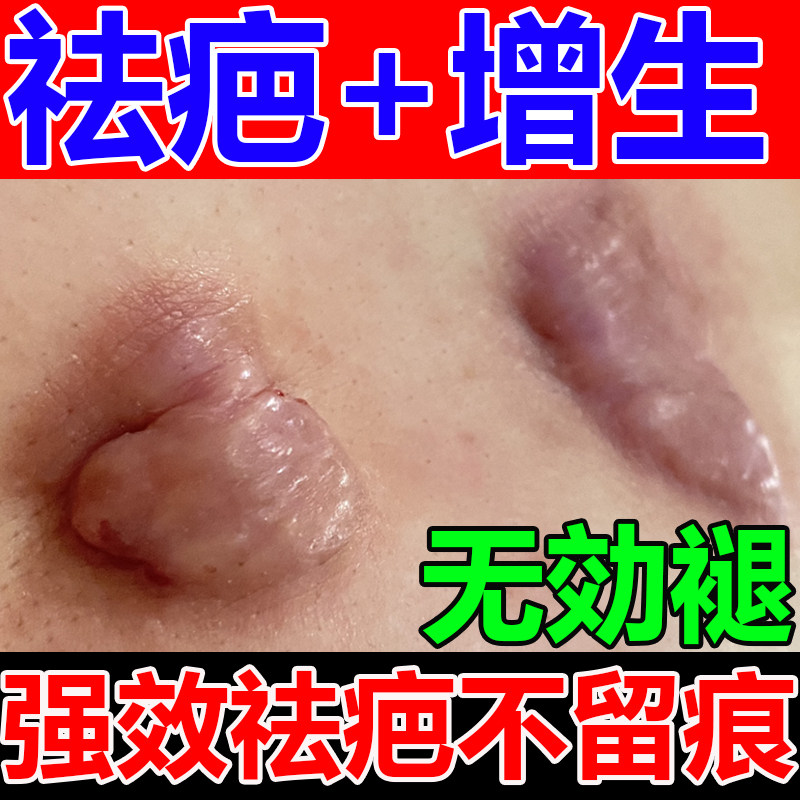 疤痕增生凸起去除胸前瘢痕疙瘩软化针修复油体质痒专用膏贴