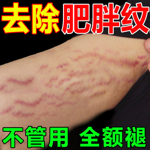 去肥胖纹修复霜生长纹消除大腿学生去除男淡化纹路祛肥胖纹修复膏