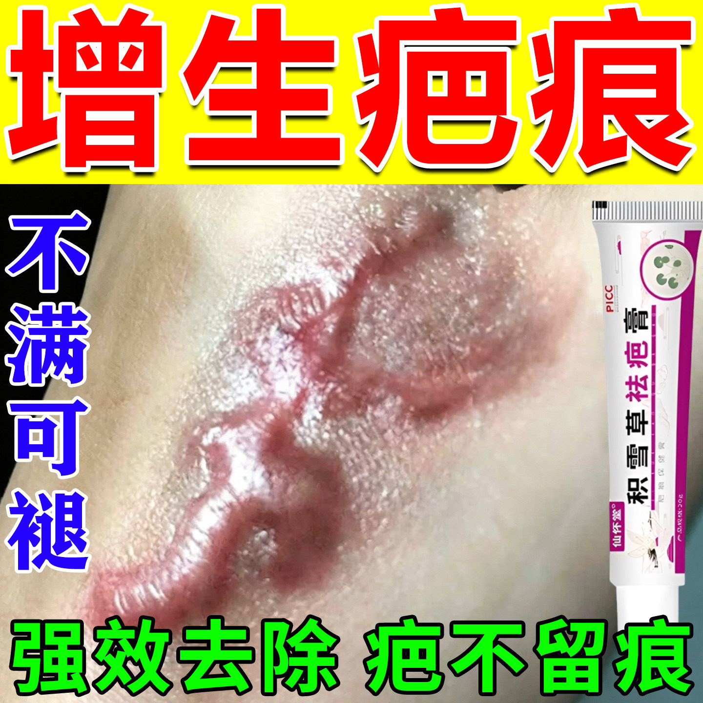 疤痕灵疙瘩胸前增生凹凸起软化修复膏去除祛伤疤痕贴耳洞刀疤药膏