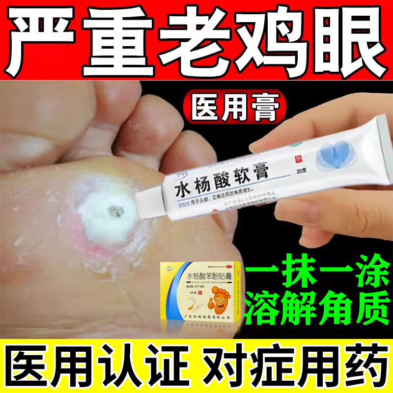 水杨酸软膏官方旗舰店正品鸡眼药膏治疗足部脚底鸡眼老茧疙瘩拓疣