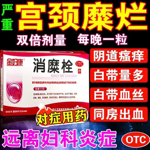 消糜栓治疗宫颈糜烂的药宫颈糜烂重度用中药白带异常房事出血