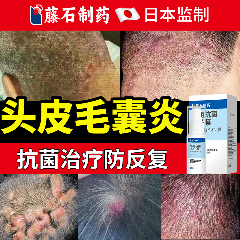 速发】头皮毛囊炎长痘痘抗菌喷剂