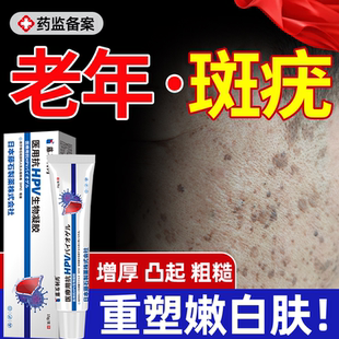 老年斑强力去除专用的药房膏祛脸上扁平疣去老人斑脂溢性角化病YS