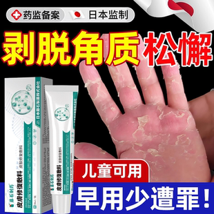 剥脱性角质松懈症松解手严重脱皮专用真菌蜕皮干燥起皮儿童手指YS