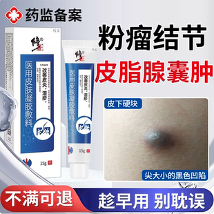 粉瘤皮脂腺囊肿专火疖子疖肿拔毒用皮下囊肿去除神器药监备案膏EM