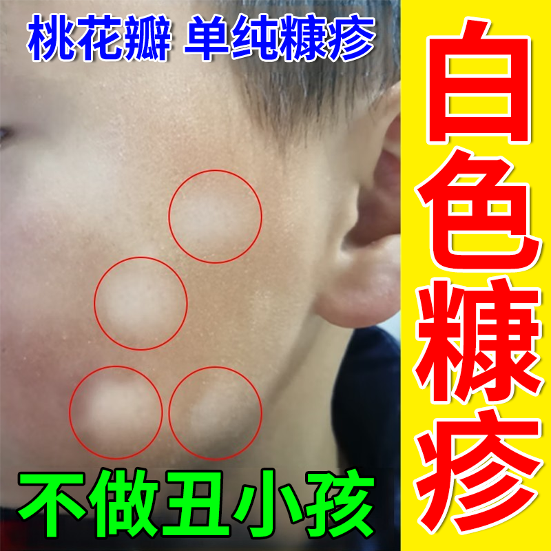 儿童脸上白色糠疹膏长白斑小孩长癣汗斑桃花癣可搭配瘙痒药膏用wy