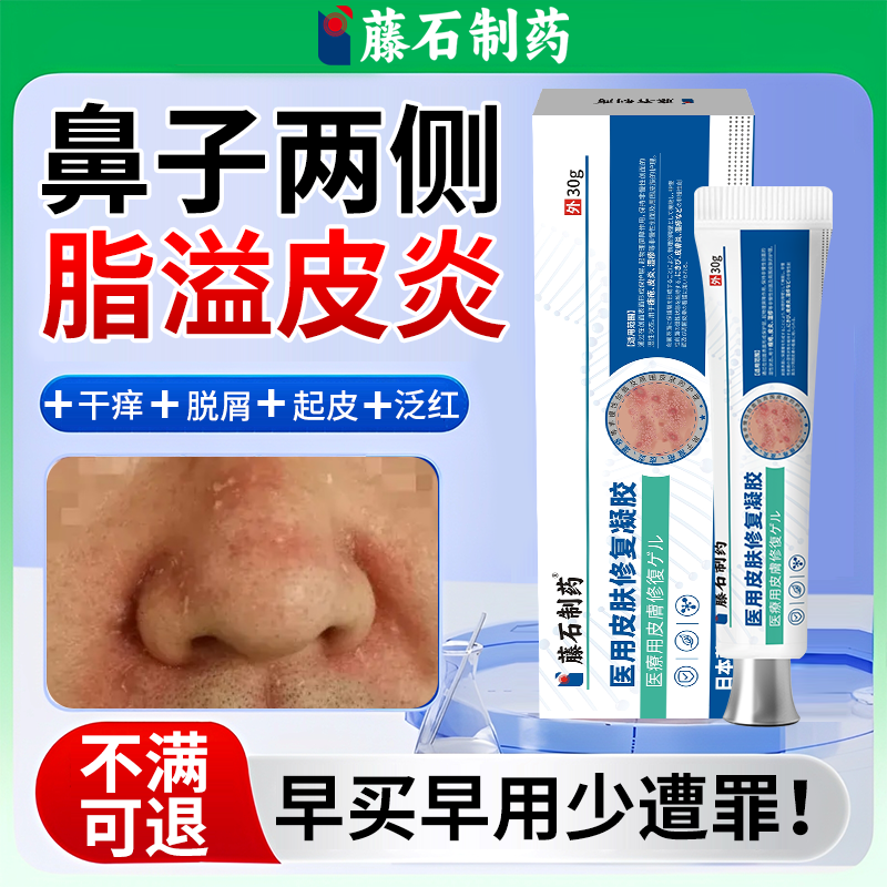 【现货速发】鼻子脂溢性皮炎软膏