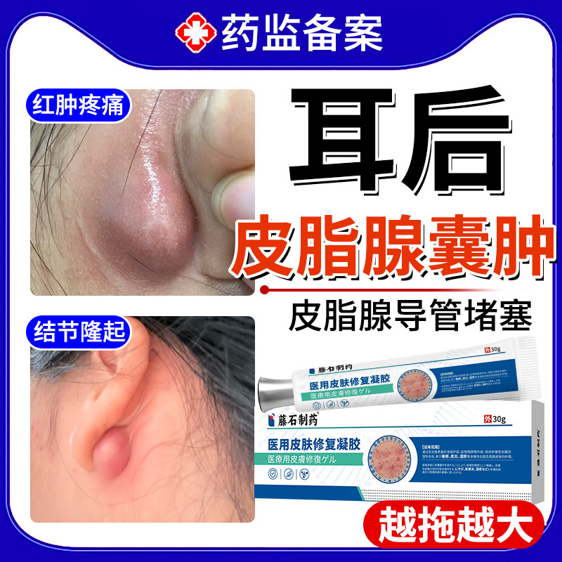 耳后皮脂腺囊肿粉瘤疖肿火疖子拔毒拔脓脓包硬块专可搭膏药贴用EM