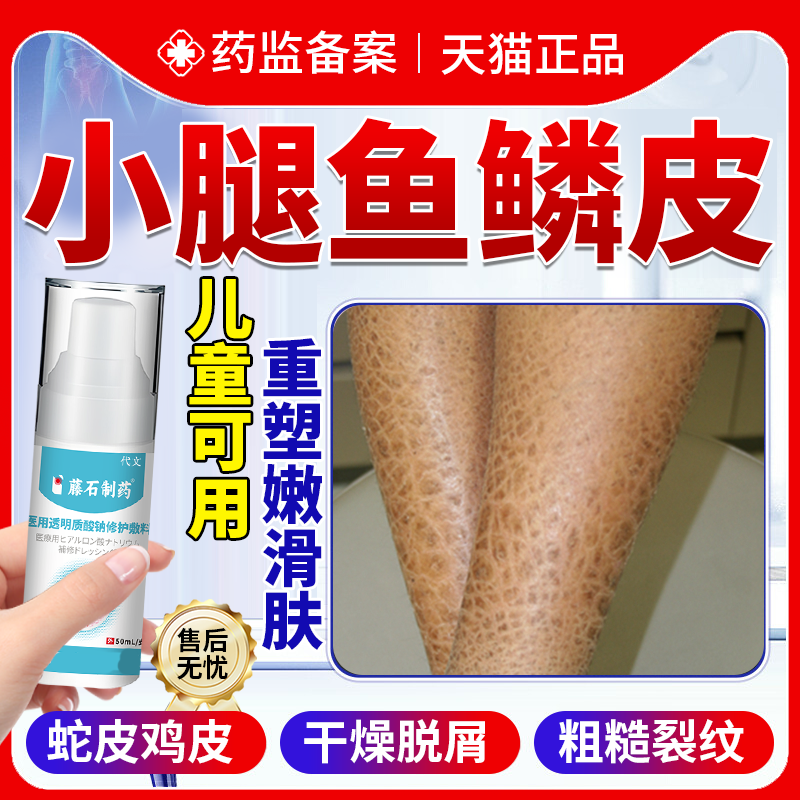 小腿干燥瘙痒鱼鳞皮肤专用身体乳药房鱼鳞病皮肤霜蛇皮肤鸡皮肤YS