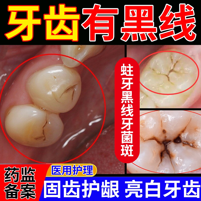牙齿去黑线黑渍牙窝沟清洁理蛀虫牙洞菌斑美白非牙膏牙缝隙发黑wy