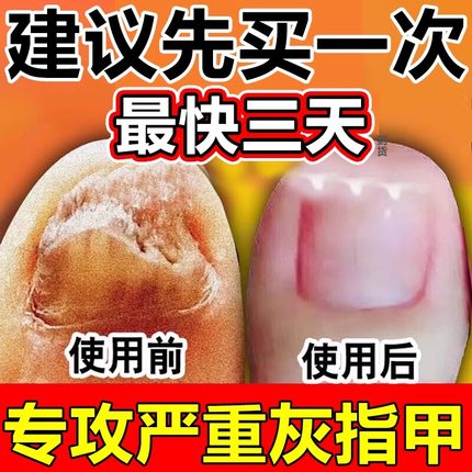 灰指甲特效新期药根能治坏甲变黄增厚亮甲灰指甲专用正品旗舰店MM