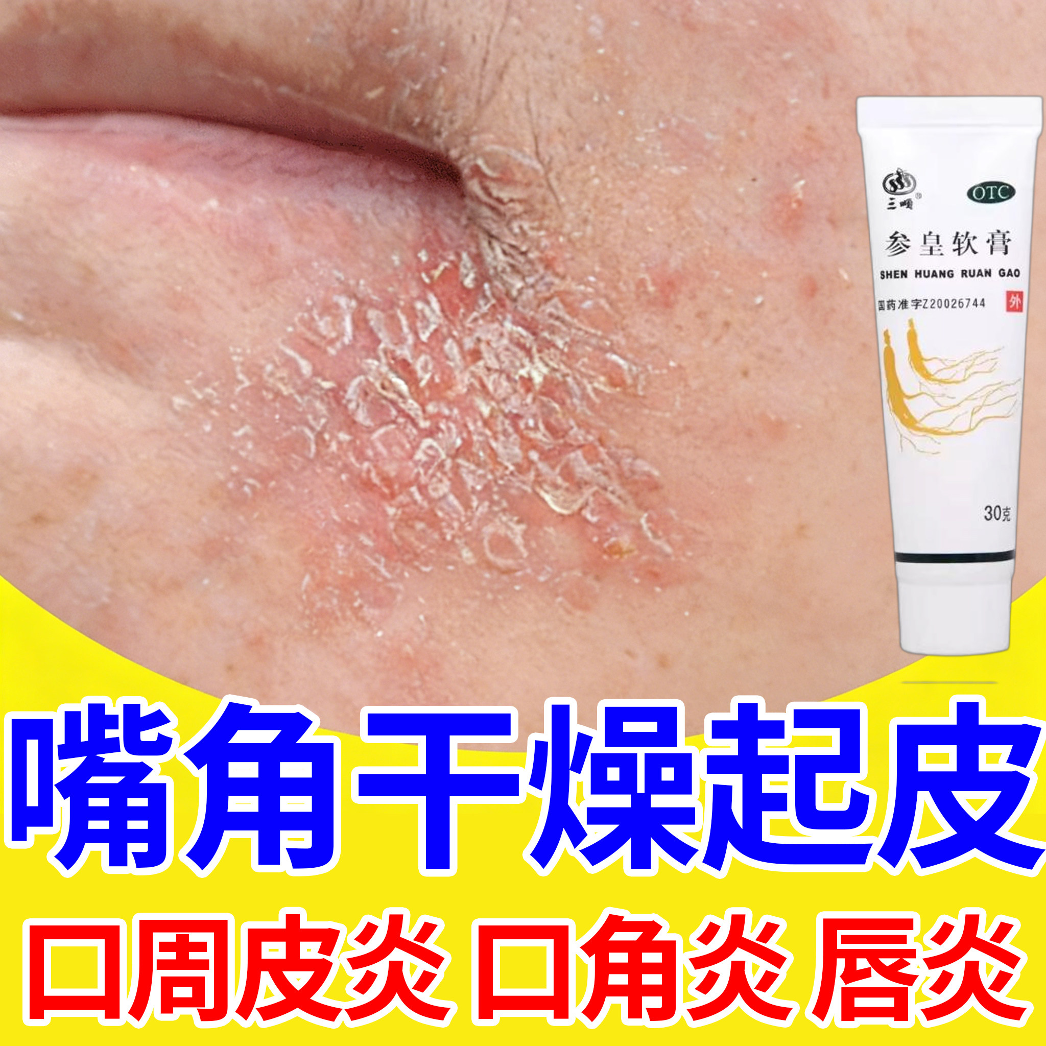 参皇软膏嘴角干燥起皮烂嘴角口角炎唇炎脂溢性口周皮炎专用药膏