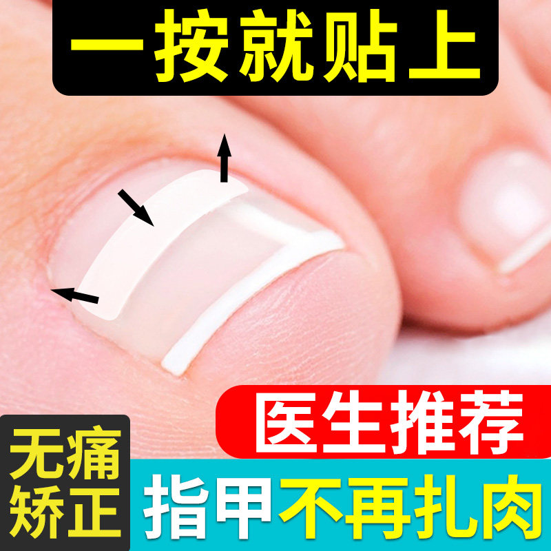 速发甲沟矫正器纠正嵌甲正甲片脚趾甲贴扣指甲长到肉里片用填充垫