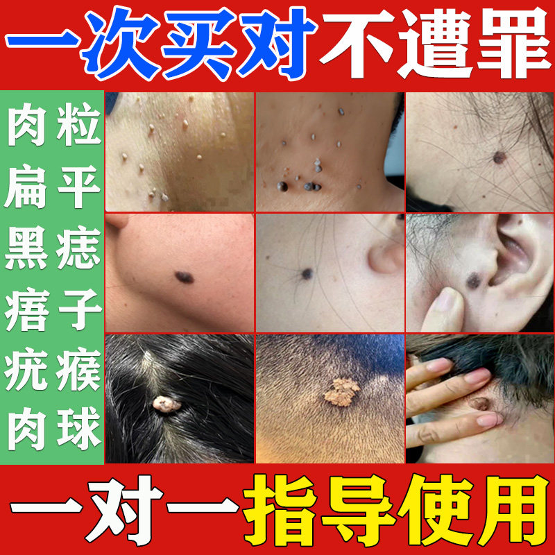 扁平丝状疣软膏去脖子疣瘊小肉粒腋下疙瘩