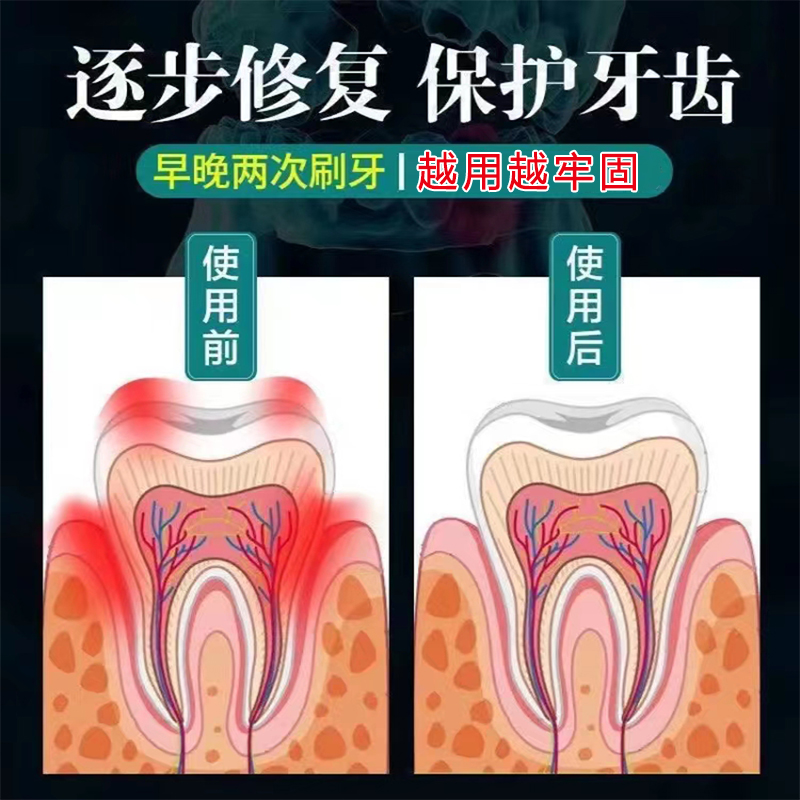 极速【当天见郊】牙松晃动神器牙龈退缩肿痛出血牙根外Y露松动咀