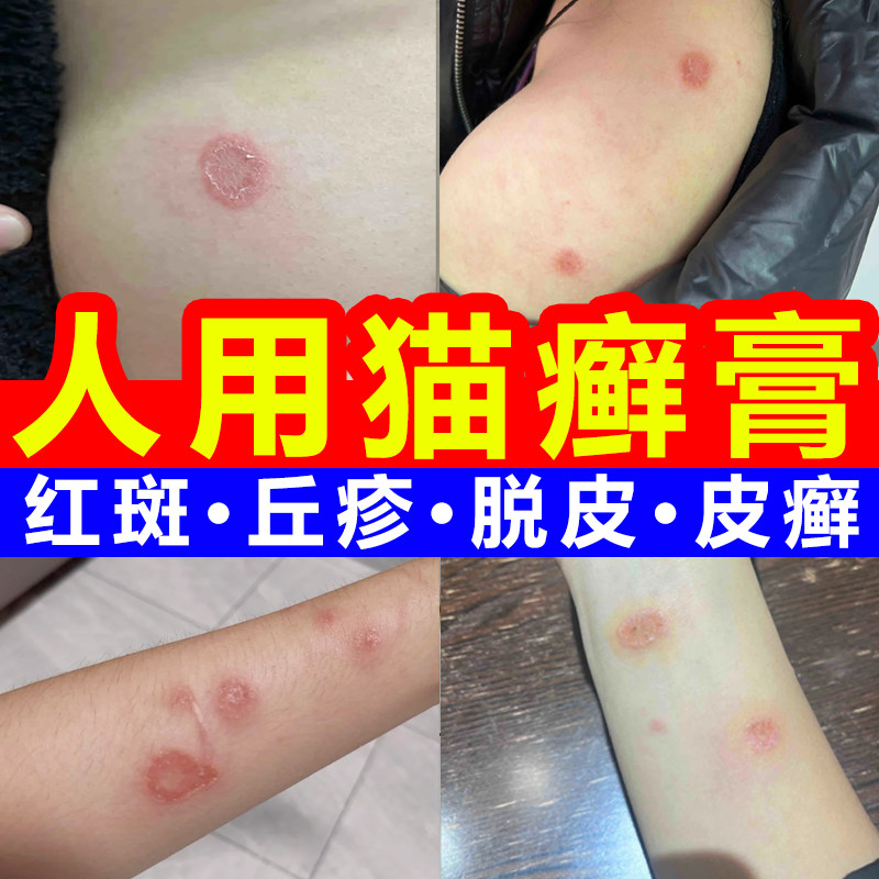 人用猫藓药猫藓外用药狗癣专用药人得了猫癣人患真菌止痒药膏治疗