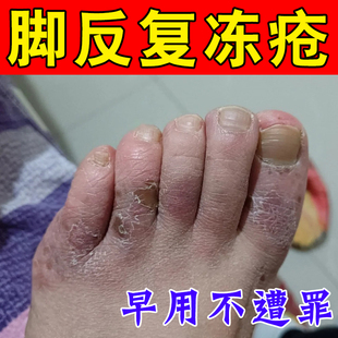 手指头冻伤冻疮膏防儿童成人手脚脸耳朵冻裂出血红肿粗糙专用