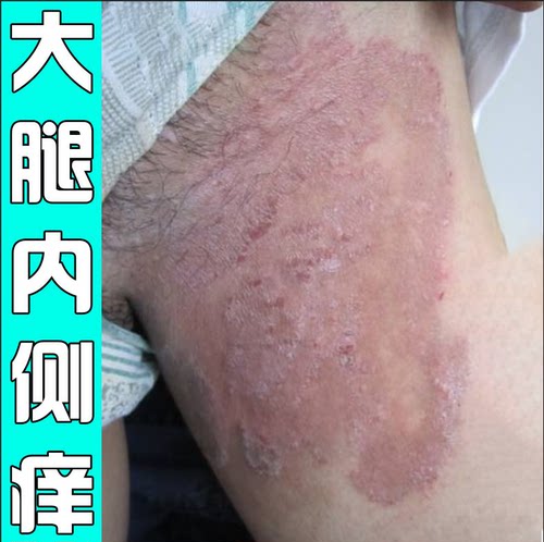 大腿内侧皮肤男士红肿疙瘩起小红点防摩擦烧裆软膏