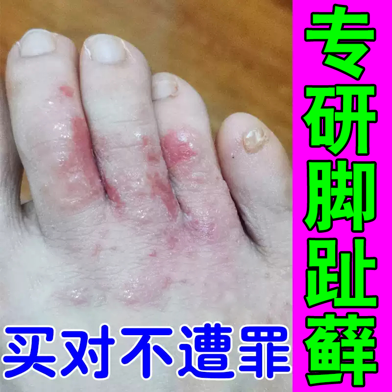 去脚趾关节鲜痒脚趾头干燥脱皮裂口起硬皮真菌感染起皮屑红斑疙瘩