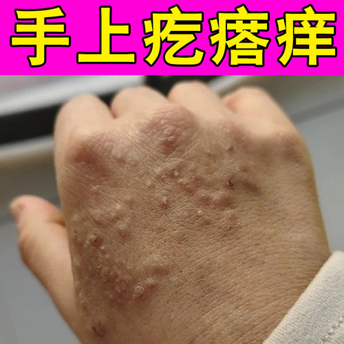手上长疙瘩手背起小红点溃烂结痂身上红肿块外用膏