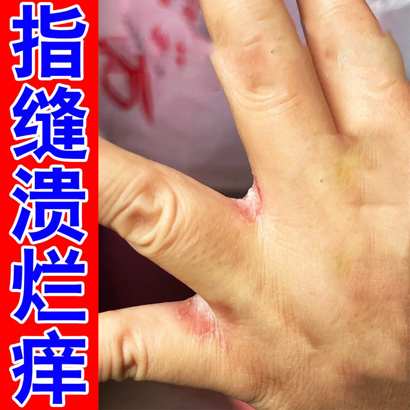 手指缝溃烂软膏红肿真菌感染经常碰水糜烂脱皮痒手指开裂皮肤粗糙
