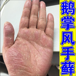 手鲜手脚严重脱皮干裂膏手手起干皮真菌感染专用软膏