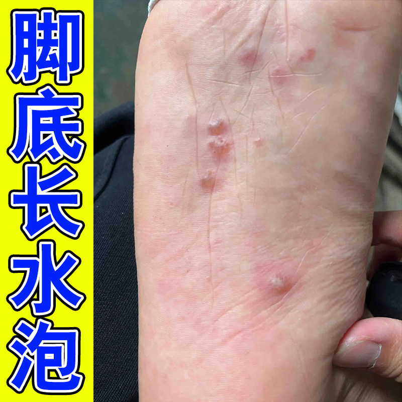 脚底起小泡脱皮脚掌心足底脚掌心起皮掉屑
