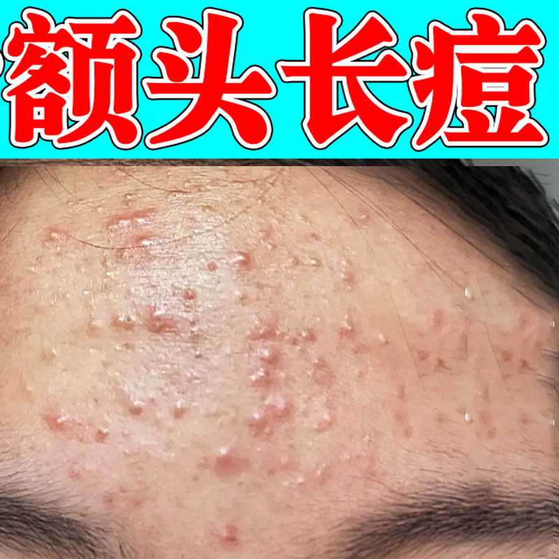 冶额头豆豆闭口小疙瘩脸部熬夜上火长豆粉刺逆光疹专用软膏