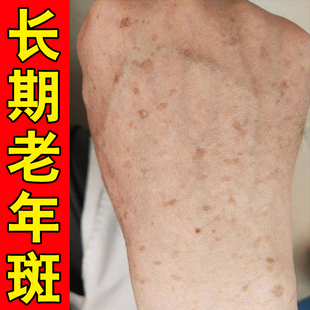 手背上的老年斑黑斑老年褐斑专用手上脸部黄褐斑日晒斑皮肤上黑斑