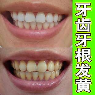 牙菌斑牙根发黑牙垢牙黑清洁牙黑斑黑渍污垢黄牙牙齿