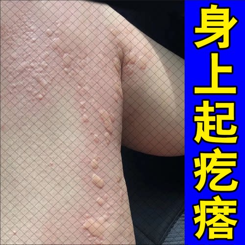 大腿起疙瘩专用膏根断风团划痕型血热风团疙瘩软膏