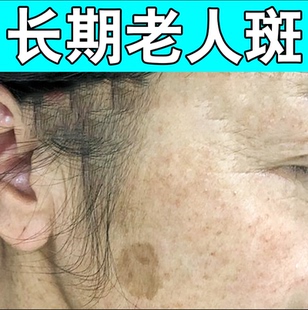 老人斑专用膏除老年黑色素脸部黄褐斑雀斑点除斑
