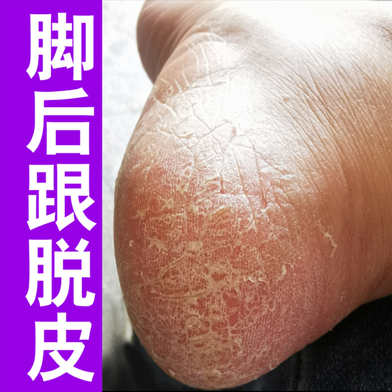 脚后跟干裂起硬皮足跟开裂皲裂脚裂手脚脱皮真菌感染修复霜