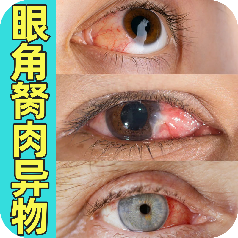 眼睛胬肉眼角滴眼液翼状息肉鱼眼眼球异物感发红发痒模糊酸胀干涩