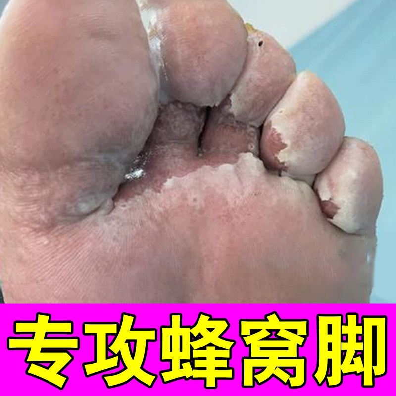 窝状角质松解症药脚底起泡脚底蜂窝状沙虫脚出汗脚臭脚出汗专用膏