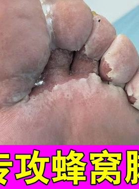 窝状角质松解症药脚底起泡脚底蜂窝状沙虫脚出汗脚臭脚出汗专用膏