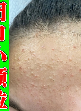 粉刺闭口脸部脸上长起小疙瘩额头收缩毛孔逆光