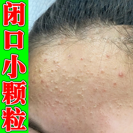 粉刺闭口脸部脸上长起小疙瘩额头收缩毛孔逆光