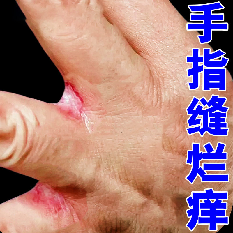 手指缝溃烂烂手丫专药用手上起小水泡发红脱皮裉去软膏