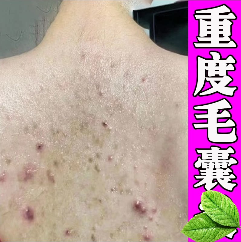 后背长豆豆胸前疙瘩发红螨虫小红皮肤消毒护理（消）