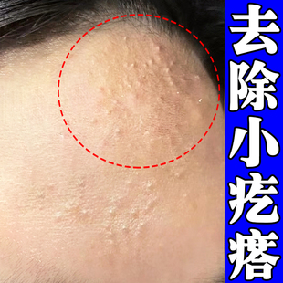 闭口粉刺脸上起小豆豆脸部额头下巴逆光疹修复软膏