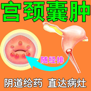 宫颈肥大纳氏囊肿药宫颈糜烂妇科凝胶炎症用药息肉修复子宫内膜UU