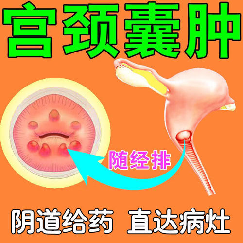 宫颈炎宫颈肥大囊肿妇科凝胶