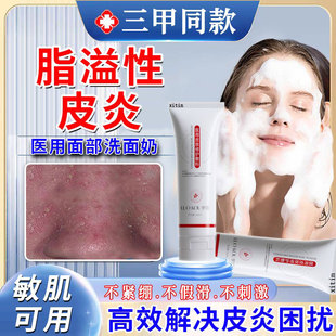 脂溢性皮炎洗面奶面部护肤品马拉色菌脂溢性皮炎鼻翼子两侧泛红GX