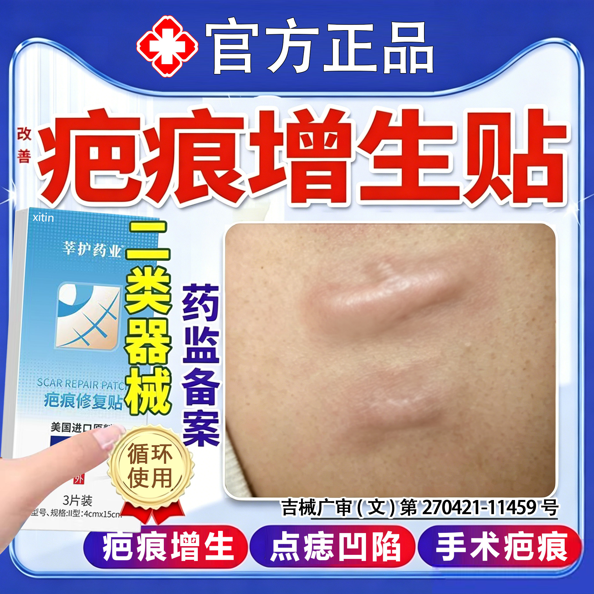 疤痕增生凸起去除疙瘩压力贴防增止生凸起硬肉减张贴剖宫产疤痕FY